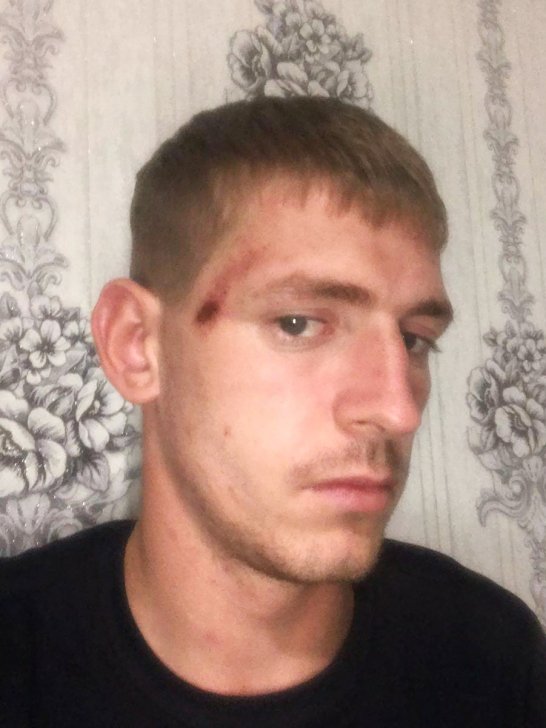 Сергей Плотников со ссадиной от избиения / Фото предоставлено Плотниковым